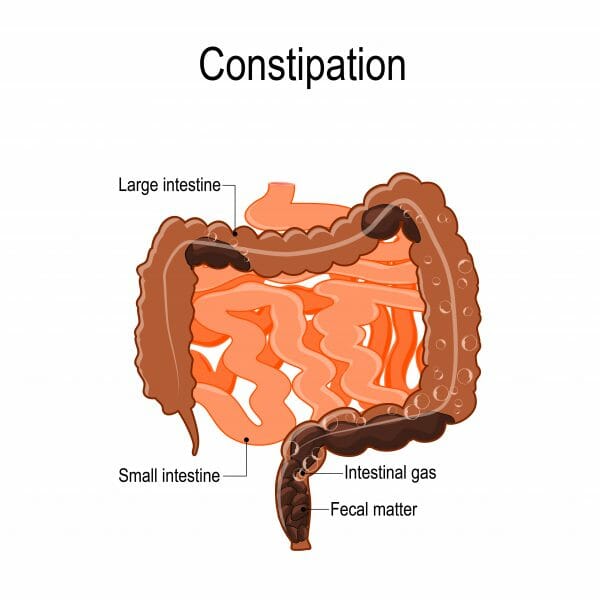 Constipation One Of The Most Common Gastric Problems Gastroenterology Mediniz