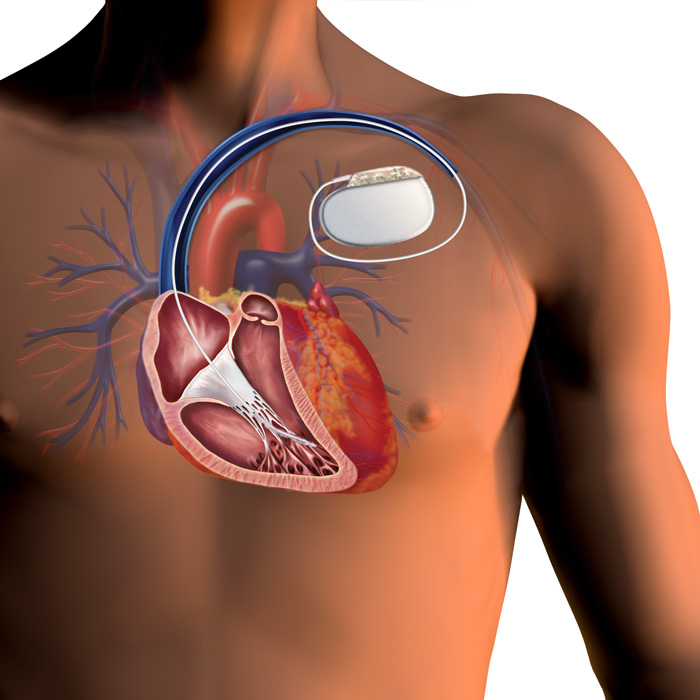 Implantable cardioverter-defibrillators