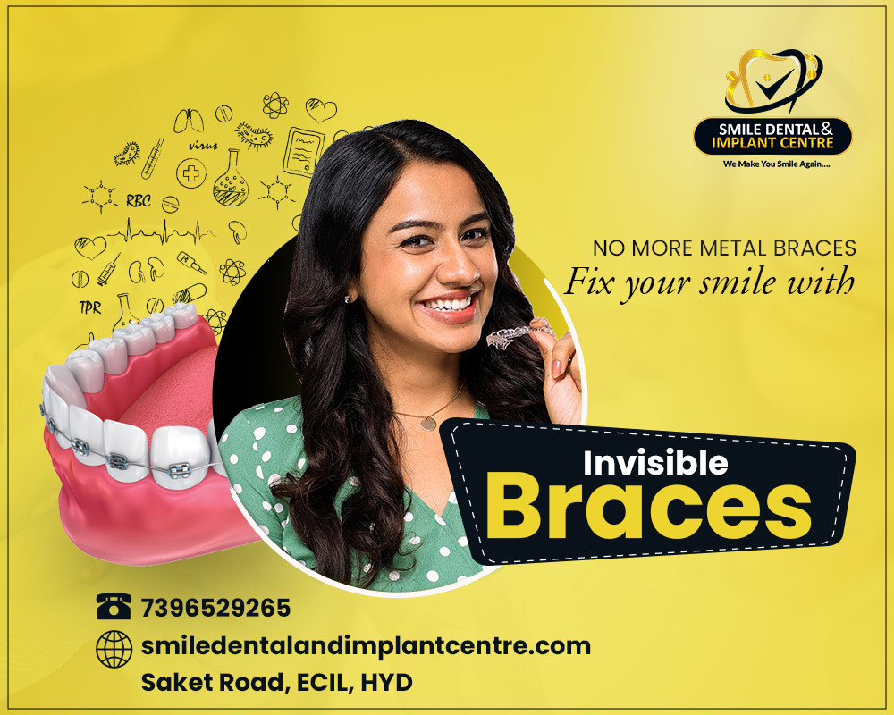 Invisible Braces for Orthodontic Treatment