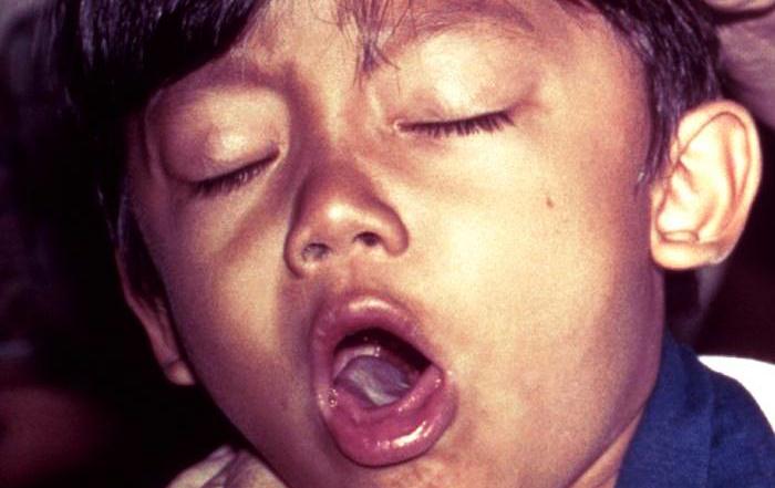 What Is Pertussis (Whooping Cough)?  Infectious Disease  Mediniz