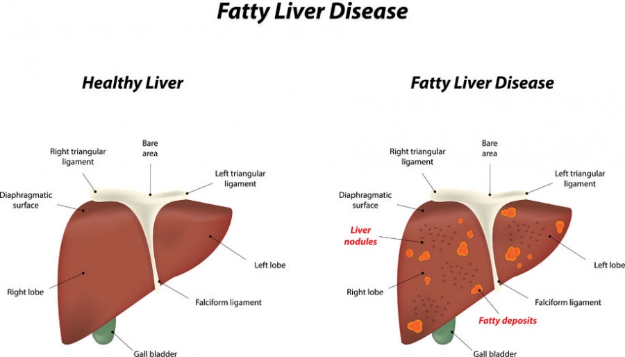 Non Alcoholic Fatty Liver Diseasenafld All You Need To Know
