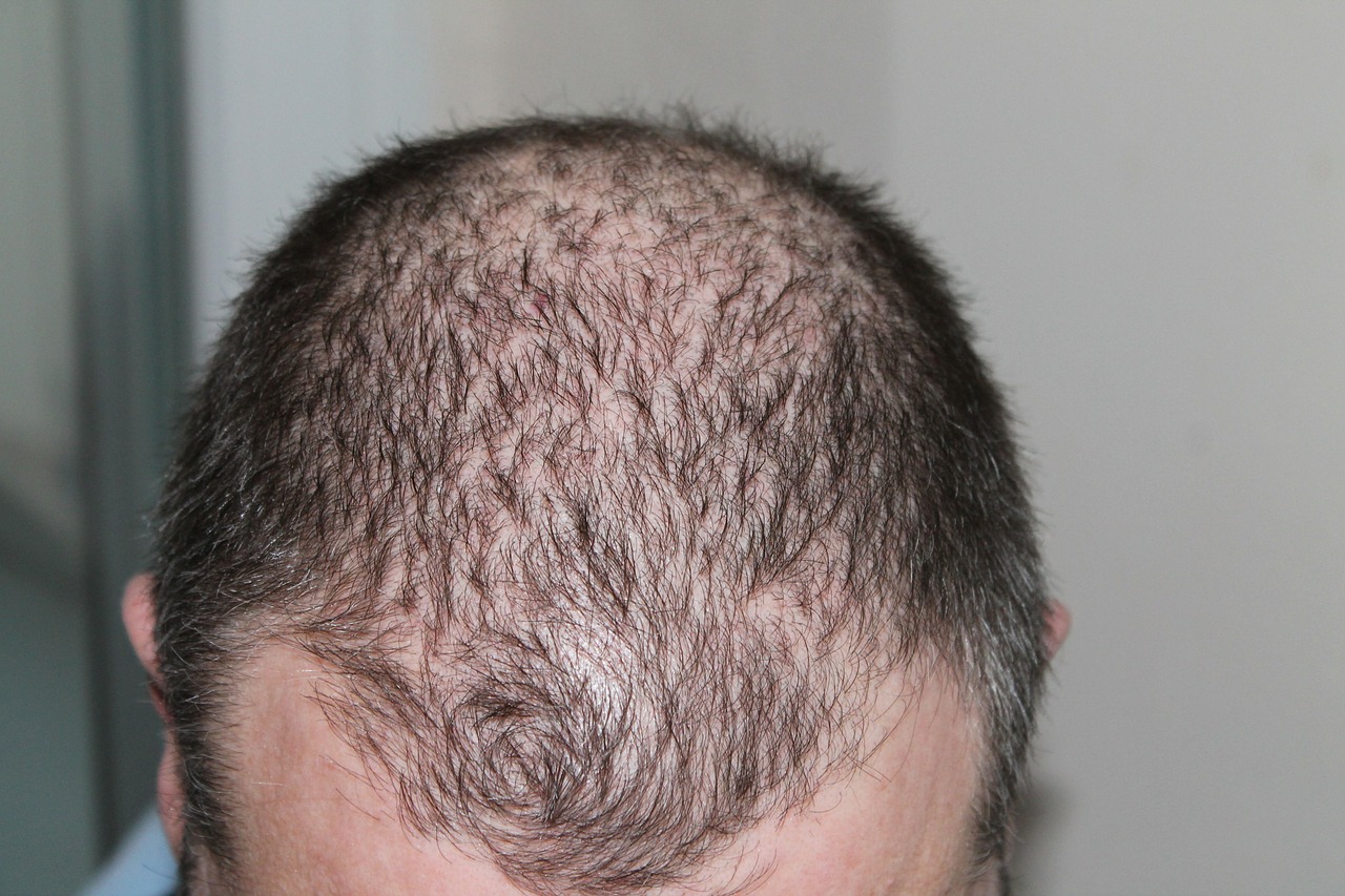 Hair Loss Treatments: What Are The Possible Options? - Dermatology -  Mediniz Health Post