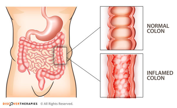 Difference Between Colitis And Irritable Bowel Syndrome Gastroenterology Mediniz Health Post 0722