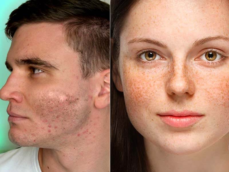11 Home Remedies To Get Rid Of Skin Pigmentation - Be Beautiful India