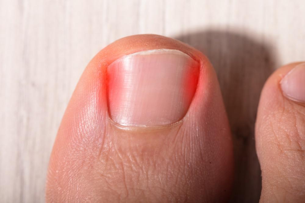 Ingrown Toenail - OrthoInfo - AAOS