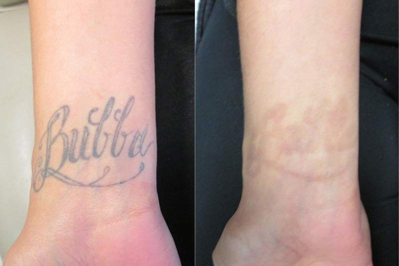 Effective Ways Of Permanent Tattoo Removal - Dermatology - Mediniz Health  Post